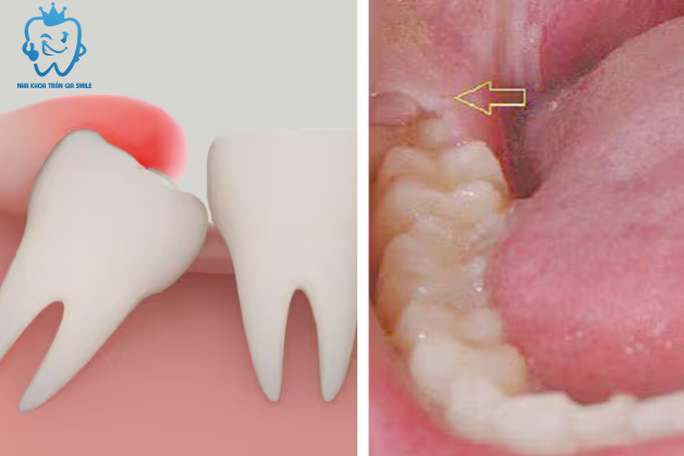 Có nhất thiết phải nhổ răng khôn