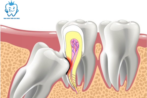 Có nhất thiết phải nhổ răng khôn