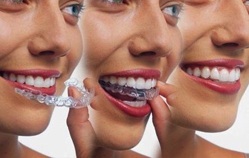 Cách sử dụng và vệ sinh khay niềng invisalign