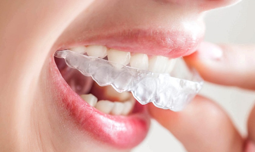 Cách sử dụng và vệ sinh khay niềng invisalign