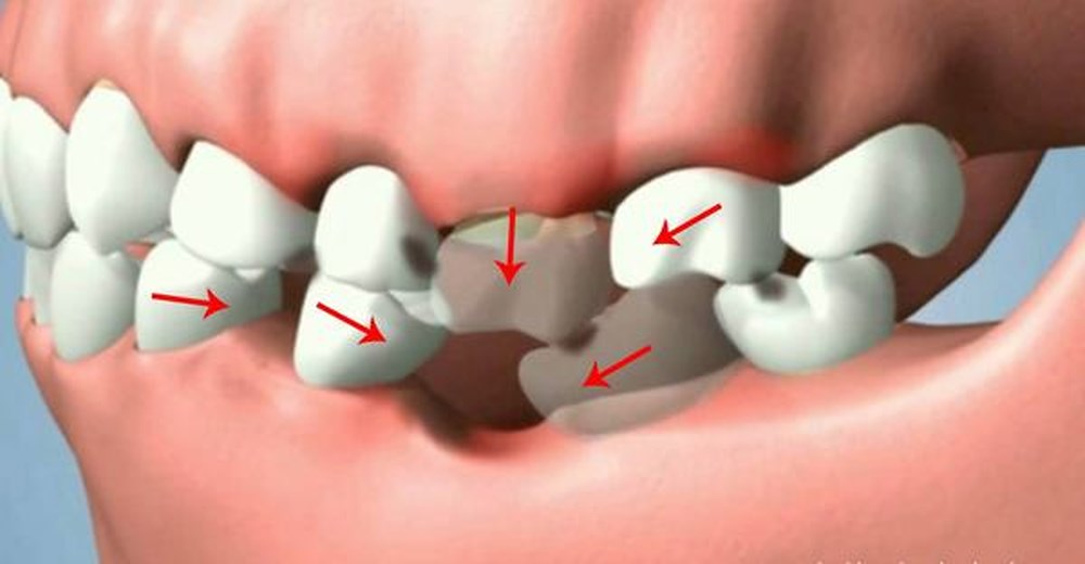 Mất răng vĩnh viễn làm xô lệch răng kế cận