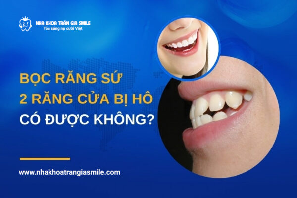 2 răng cửa bị hô - Bọc răng sứ có được không?